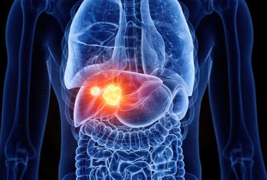 Câncer no fígado e metástases hepáticas: sinais de alerta, diagnóstico e quando a cirurgia é indicada